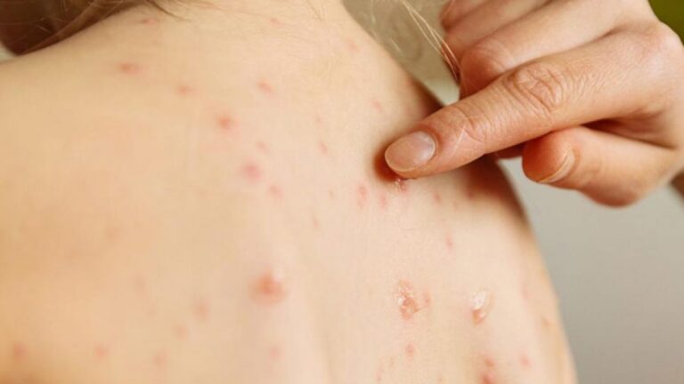 Por un alerta de Fiebre Amarilla en algunos municipios, recomiendan vacunarse