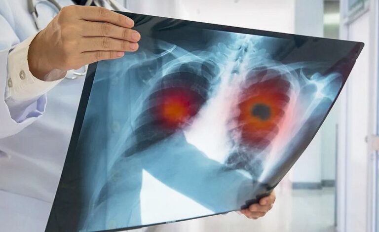 Tuberculosis en Salta: ya se registraron 400 casos y advierten por los síntomas de alerta